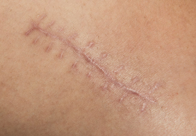 Surgical Scar Removal