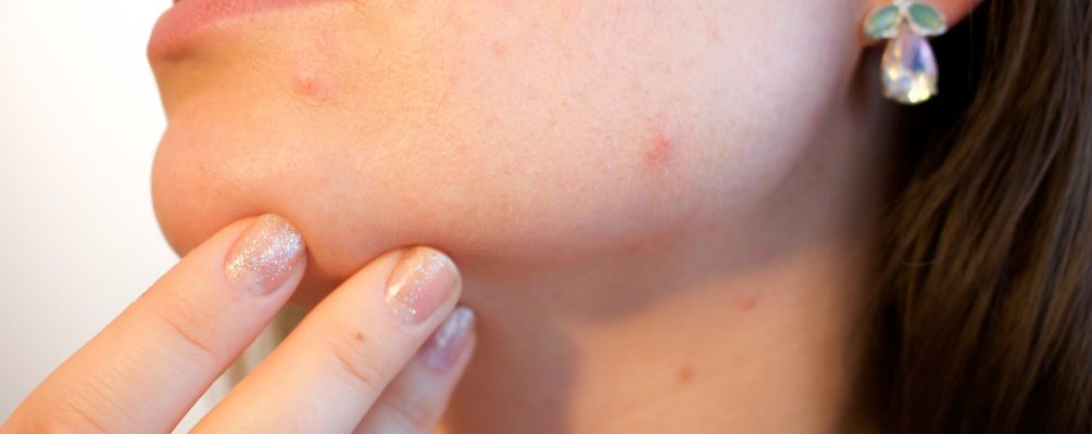 Best Scar Treatment – Top Removal Cream, Essential Oils & Home Remedies in 2018