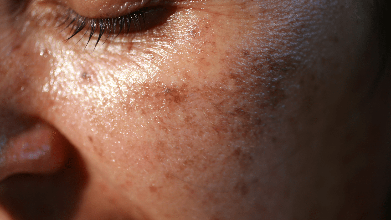 Melasma vs. Sun Spots - Understanding the Differences, Causes & Treatment