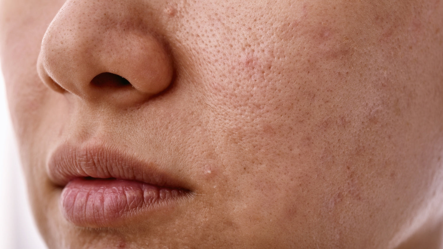 Hyperpigmentation Around Mouth - Causes & How to Treat It?