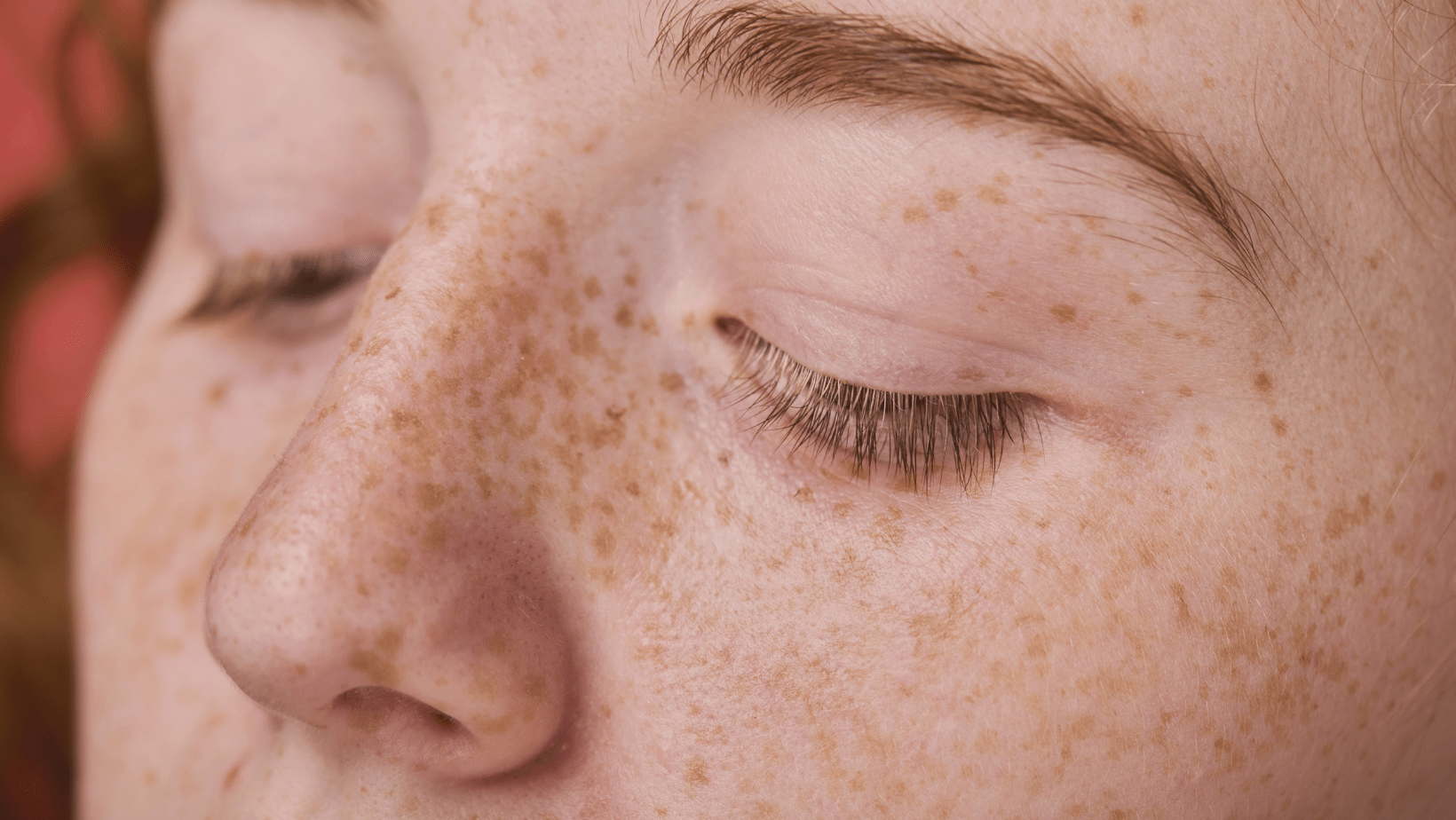 Melasma vs. Freckles - The Differences, Causes, and Treatments