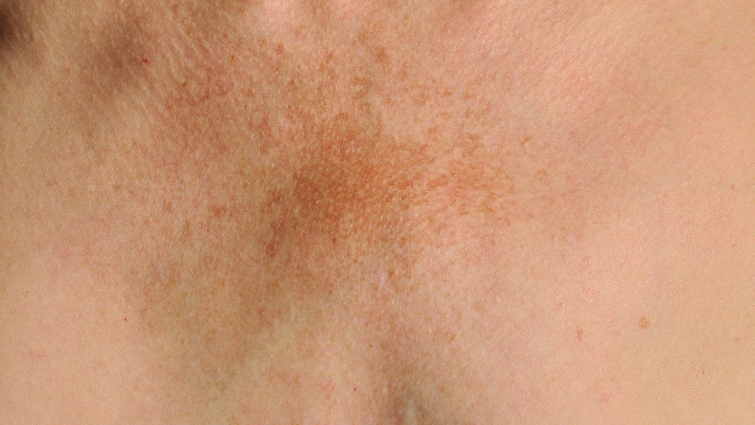 What Is Melasma? A Comprehensive Guide to Causes & Treatment