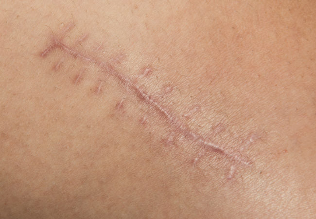 How to Remove Surgical Scars