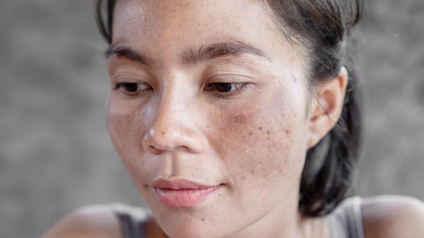 Melasma vs Hyperpigmentation - Differences and Treatment Options