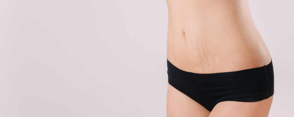 Say Goodbye to Stretch Marks - 5 Natural Solutions for Smoother Skin